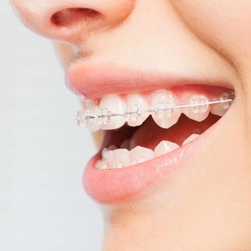 Orthodontics : clear brace