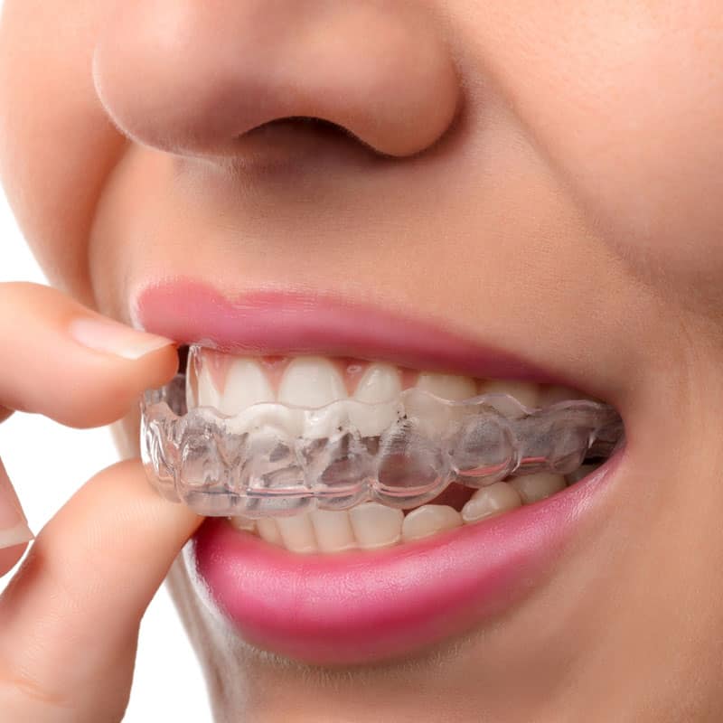 Orthodontics - clear aligner being inserted into mouth