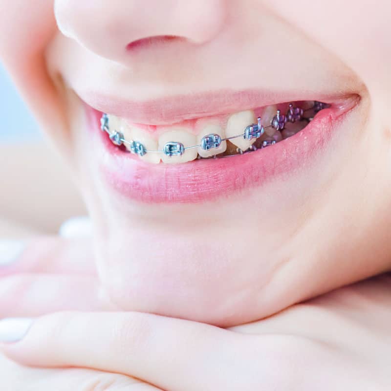 Orthodontic brace in smiling mouth
