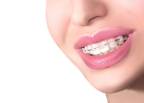 Orthodontics services: Six month smiles at Holmes Dental Care