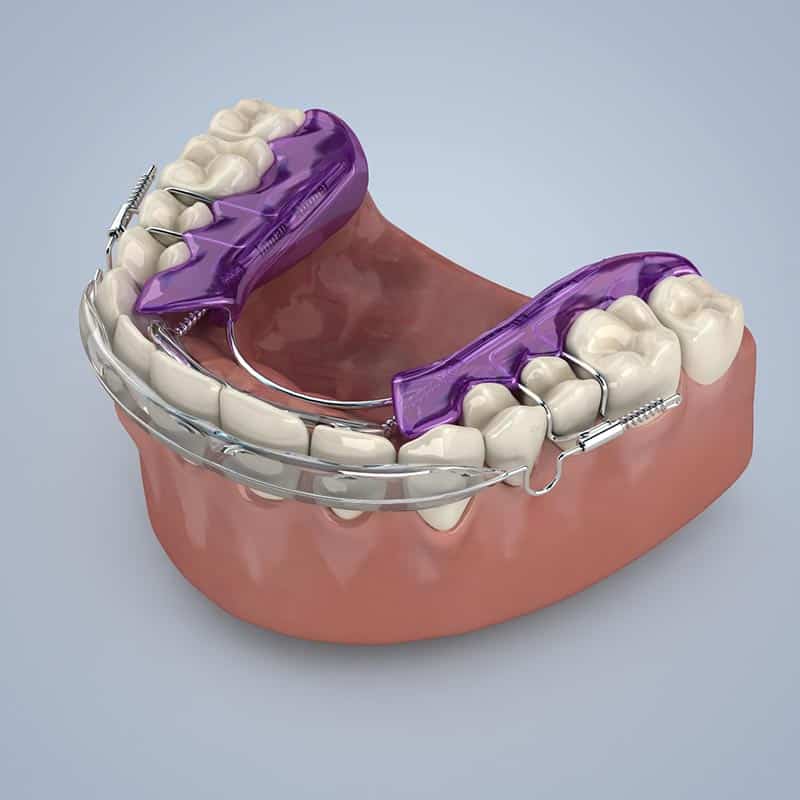Inman Aligner - orthodontics at Holmes Dental Care